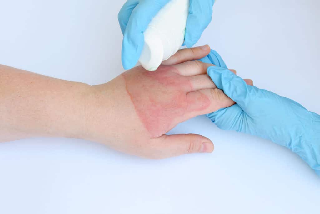 Doctor's hands holding female hand with second degree burns on white background.