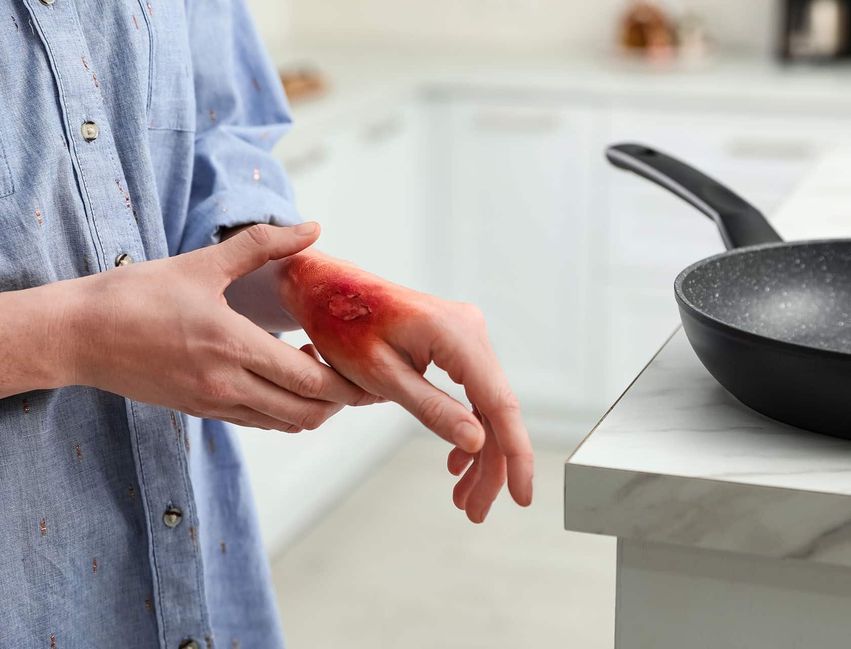 Woman with burn on her hand in kitchen