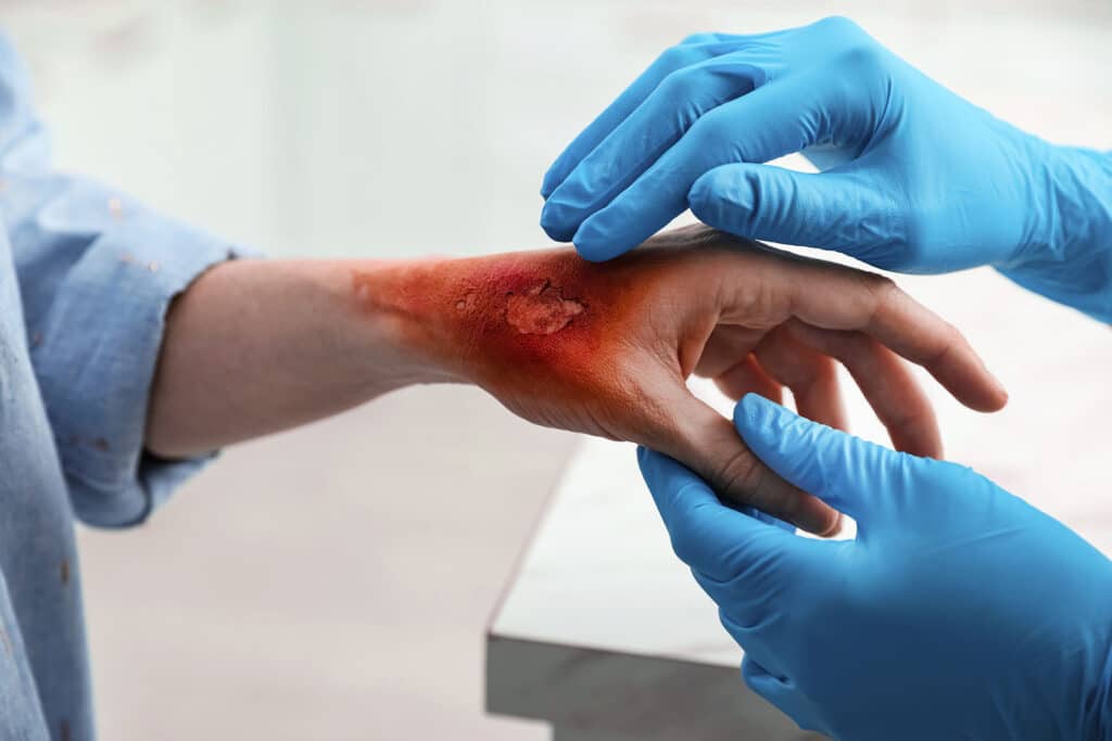 Doctor examining terrible patient's burn of hand indoors