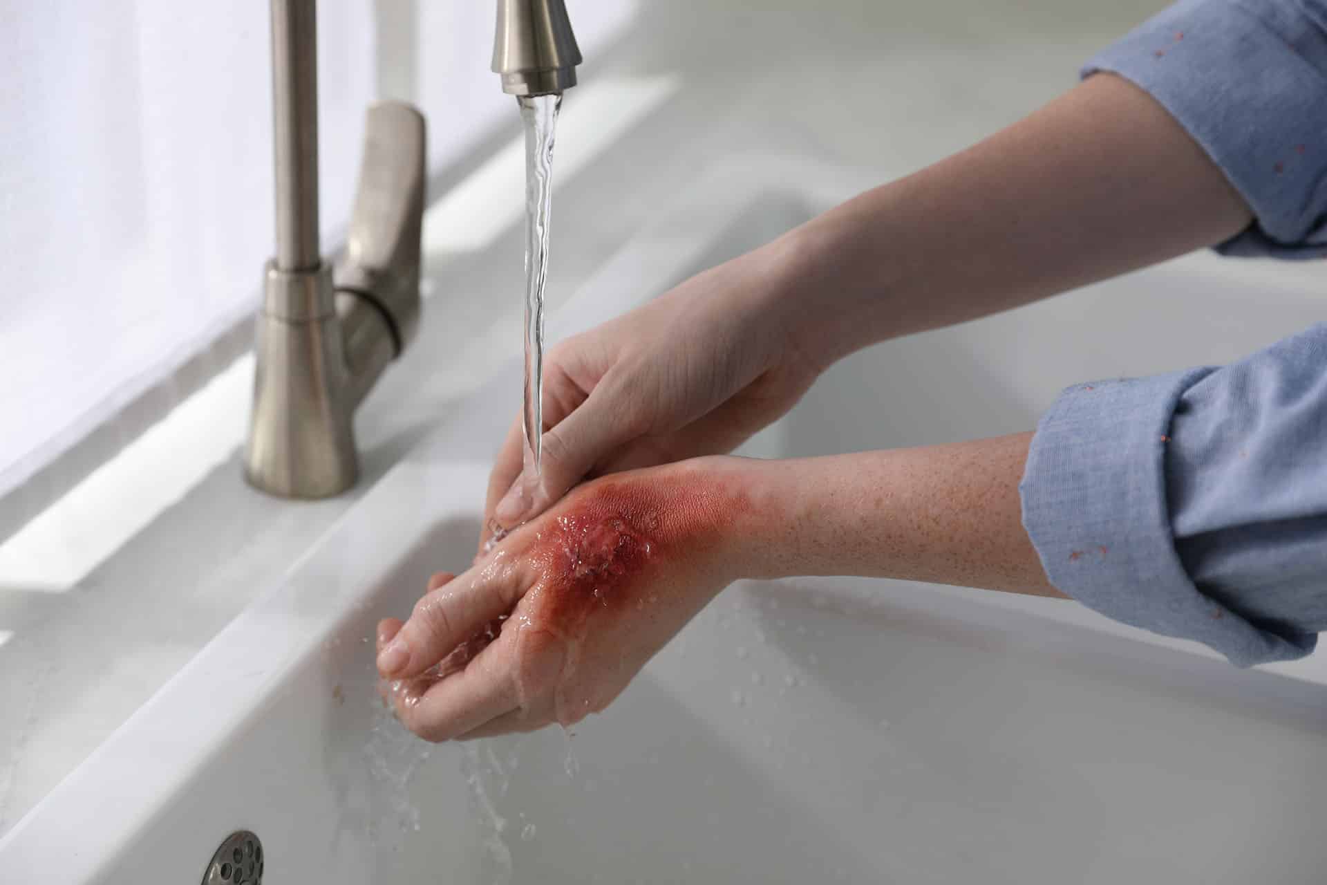 Woman holding hand with burn under flowing water indoors