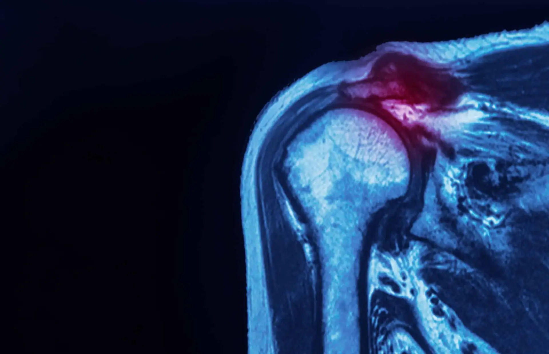 mri photo of a torn rotator cuff