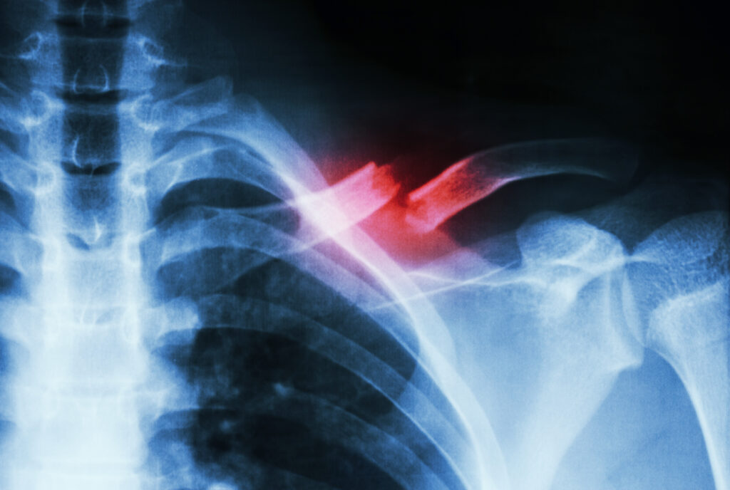 mri image of a broken collarbone with the break highlighted in red