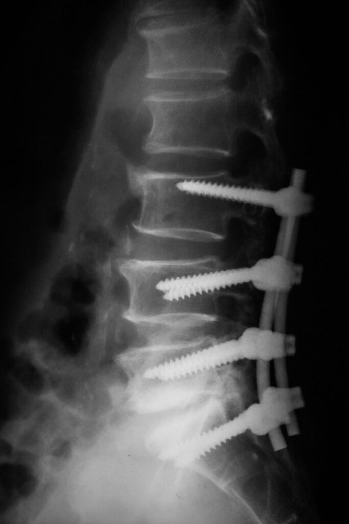 an x-ray image of a lower back with pins and screws in the vertebrae