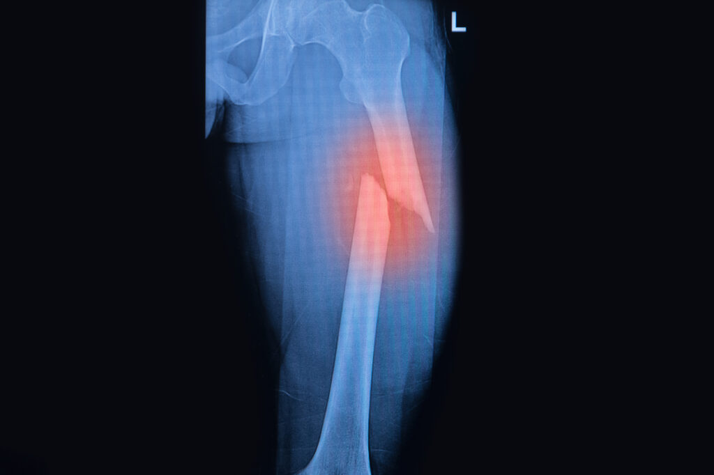 a highlighted mri photo of a broken femur highlighted with red