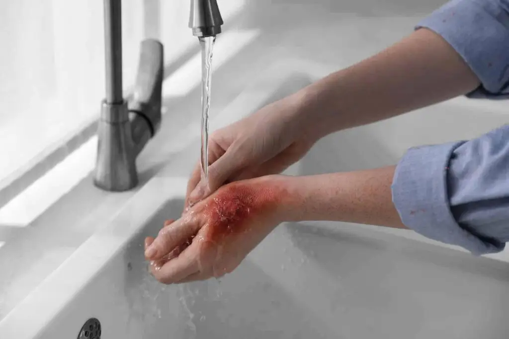 Woman holding hand with burn under flowing water indoors