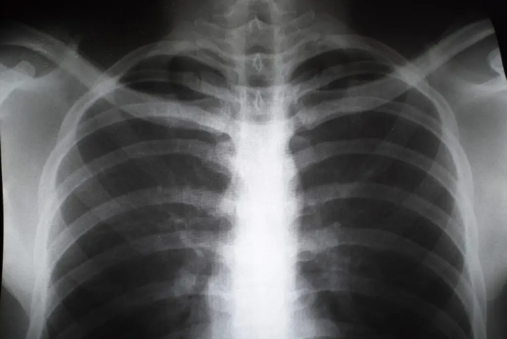 Broken sternum x-ray