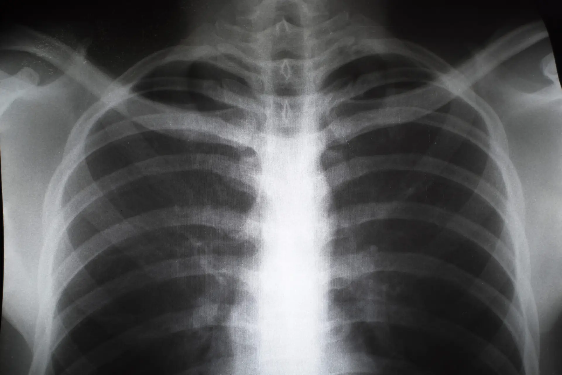 broken sternum x-ray